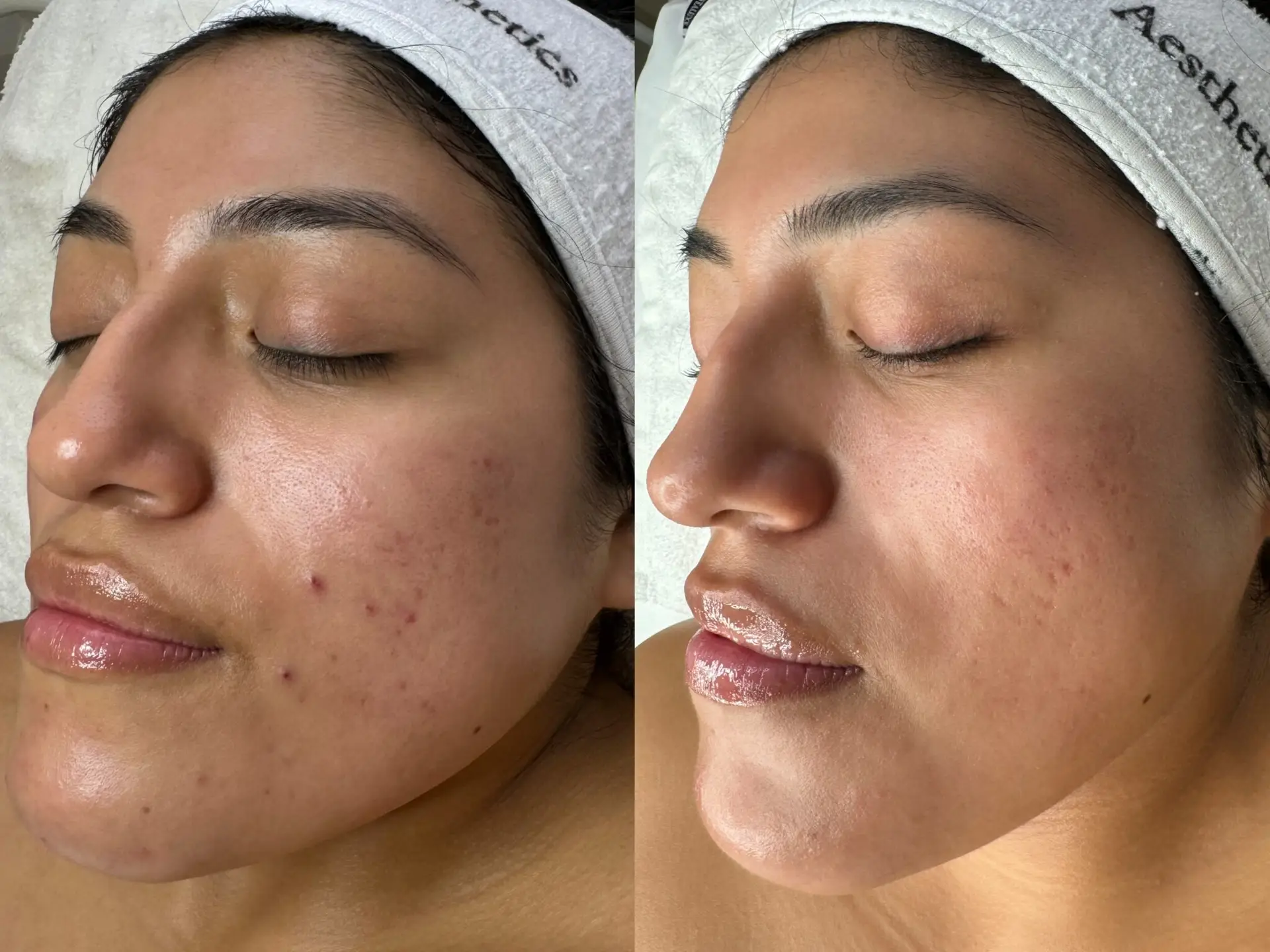 Before and After11